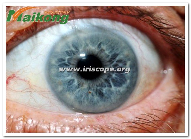 How to Read an Iridology Chart?