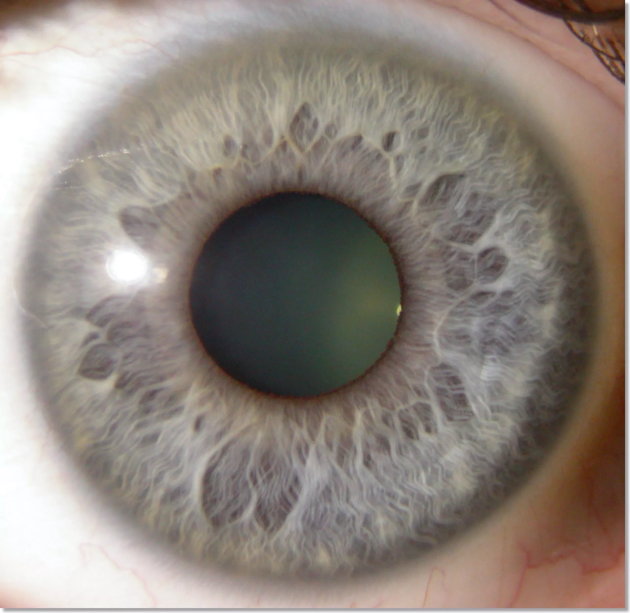 how to tell if you have parasite with iridology