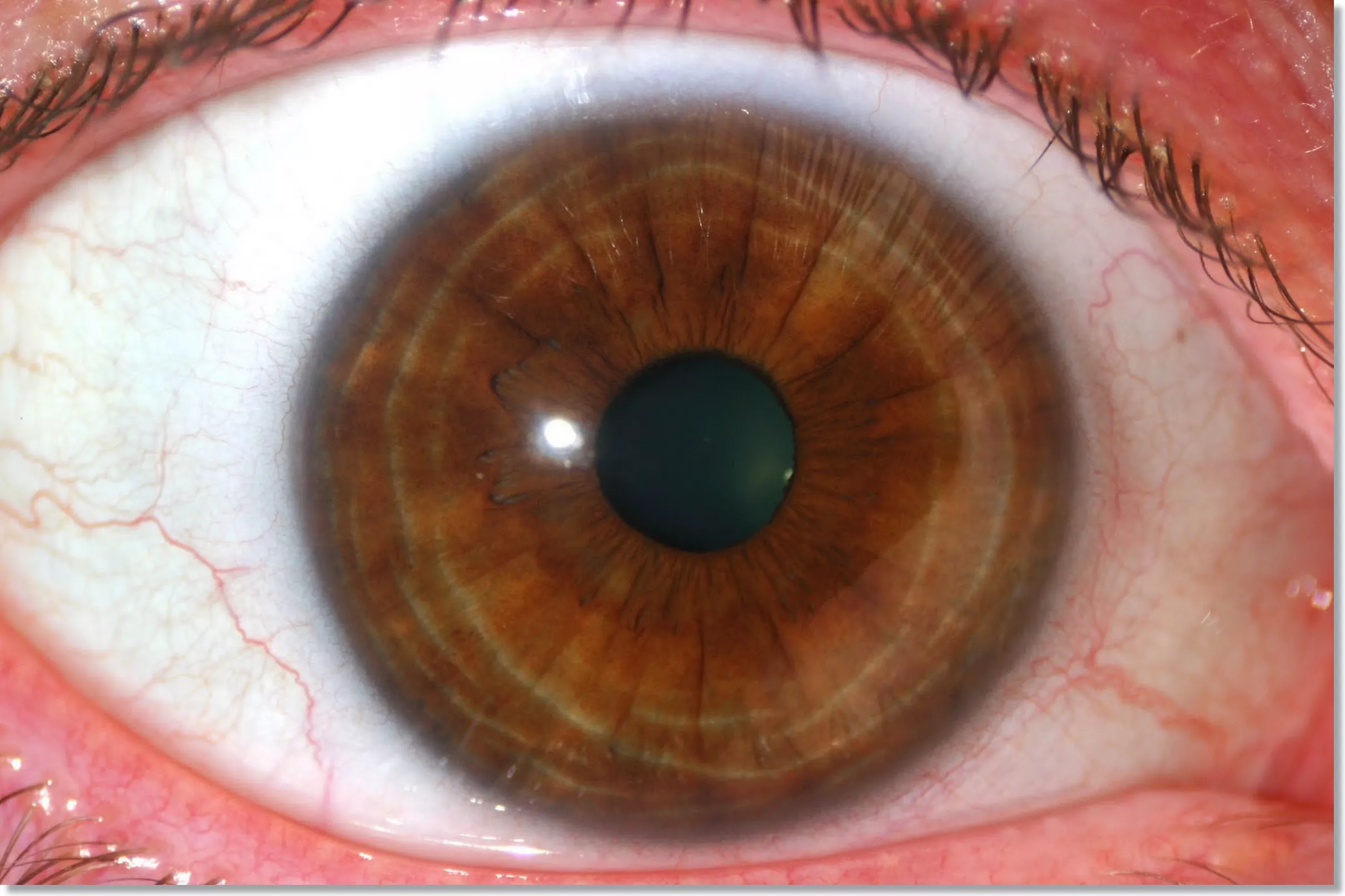 how to tell if you have parasite with iridology