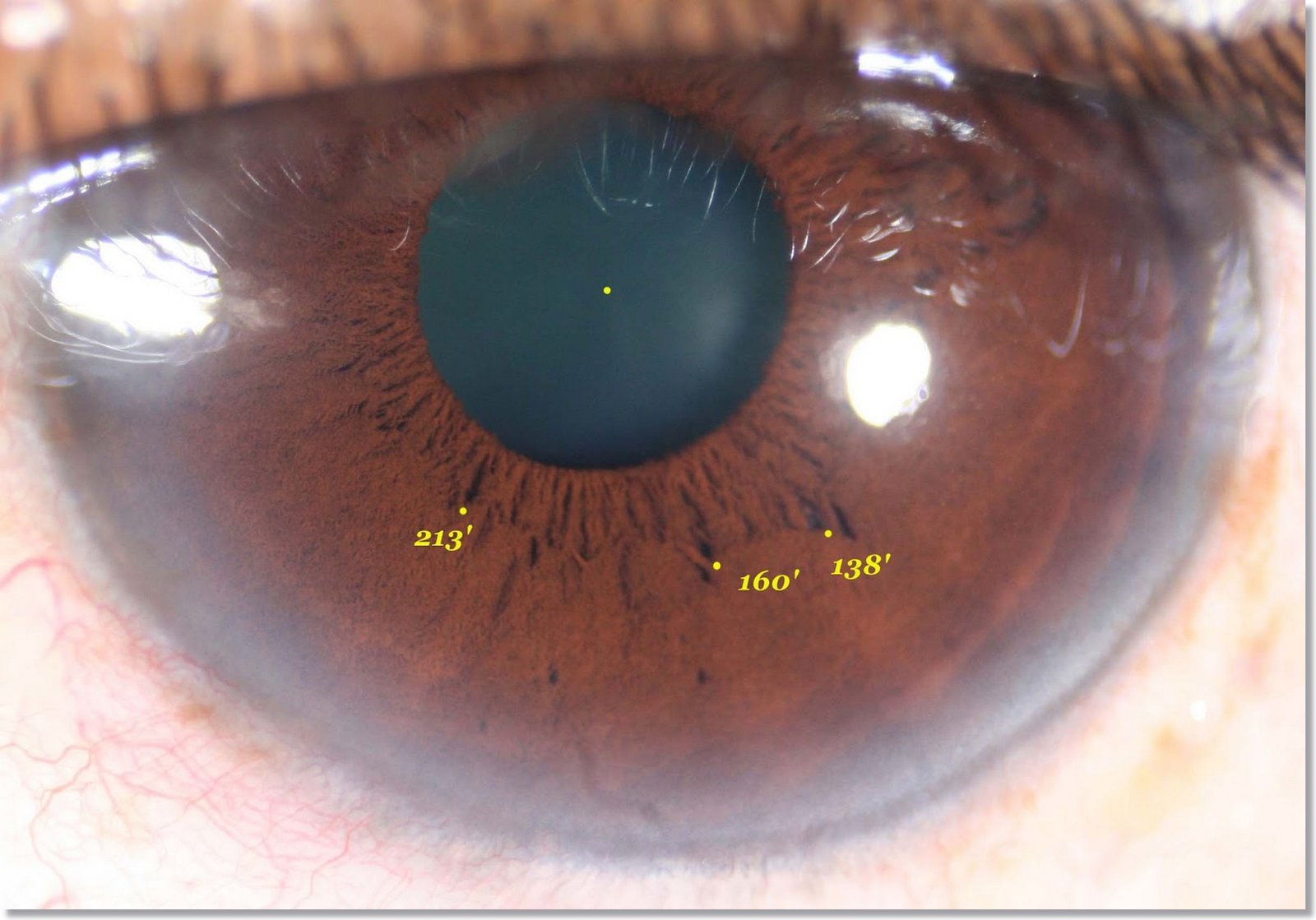 Iridology Orange Color