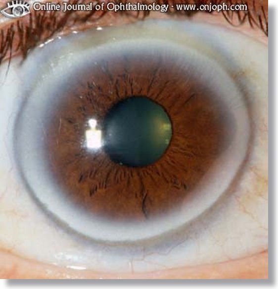 Iridology Orange Color