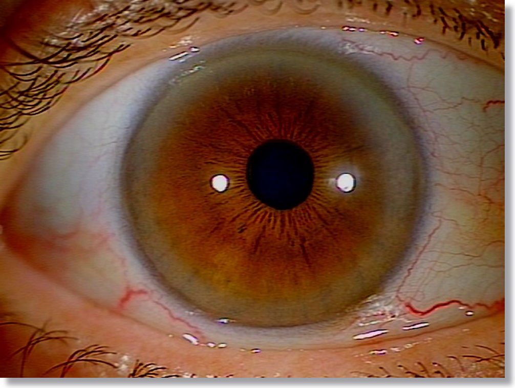 Iridology Orange Color