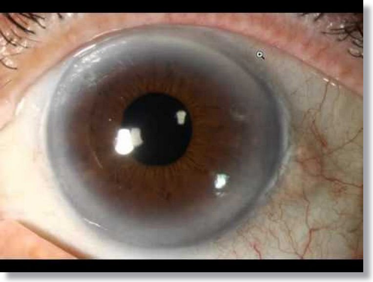 Iridology Orange Color